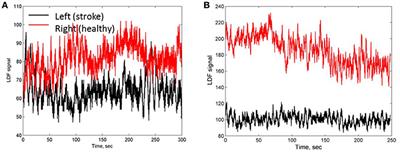 Bifurcation in Blood Oscillatory Rhythms for Patients with Ischemic Stroke: A Small Scale Clinical Trial using Laser Doppler Flowmetry and Computational Modeling of Vasomotion